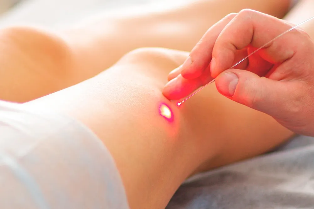 Laser endovenoso para tratamento de varizes